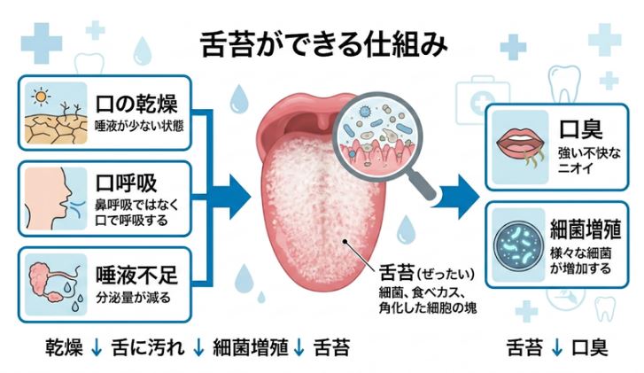 舌苔ができる仕組みと原因（乾燥・口呼吸・唾液不足）を示すインフォグラフィック