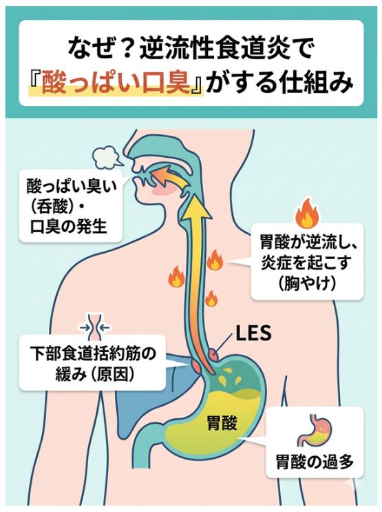 逆流性食道炎で酸っぱい口臭が発生するメカニズムの図解