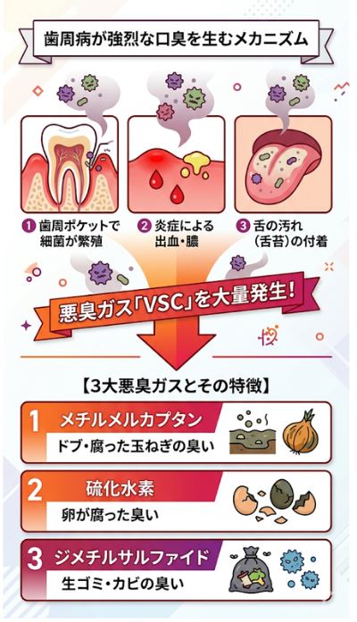 歯周病で口臭が発生するメカニズムと3大悪臭ガス（メチルメルカプタン等）の特徴