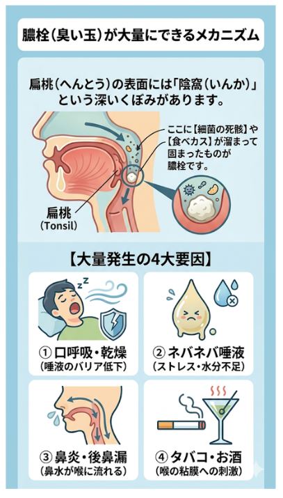 膿栓が大量に発生する原因と扁桃(陰窩)のメカニズム図解